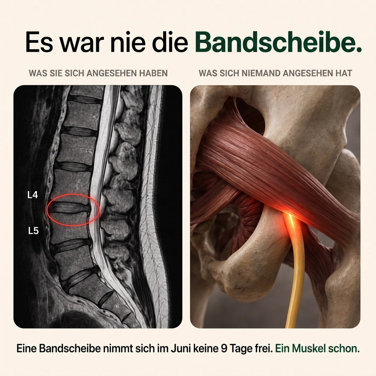 Es war nie die Bandscheibe – sondern ein Muskel, der den Nerv umklammert